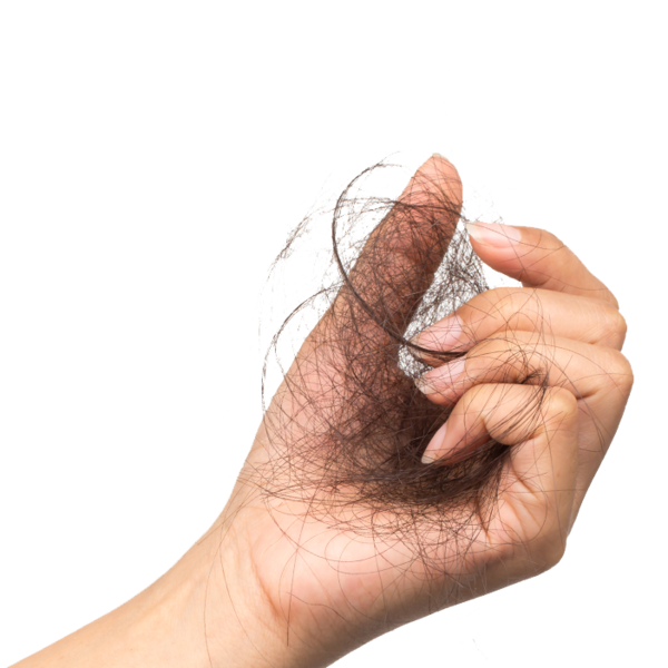 Polycystic Ovary Syndrome (PCOS) and hair loss